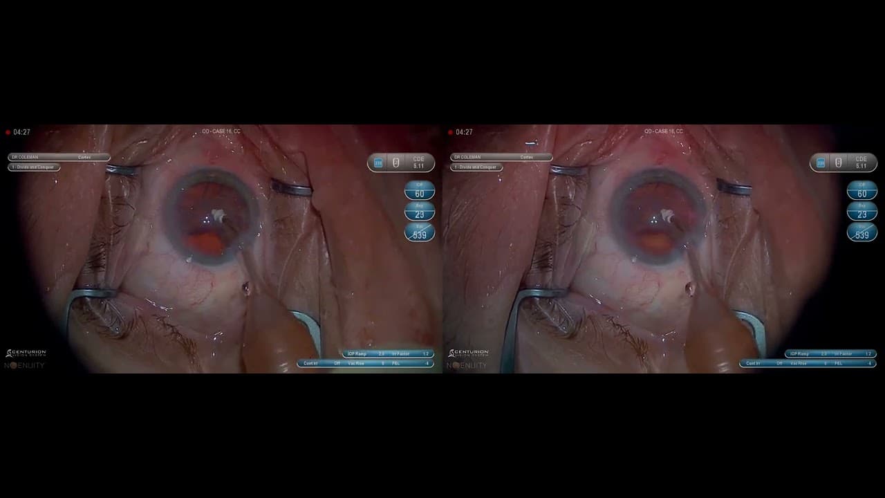 3D Surgery: Basics of Phacoemulsification: Cortex Removal (Part 5/6) - YouTube