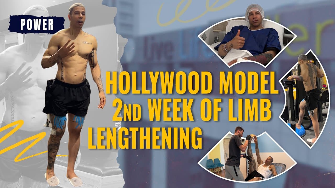 HOLLYWOOD MODEL 2ND WEEK OF LIMB LENGTHENING - YouTube