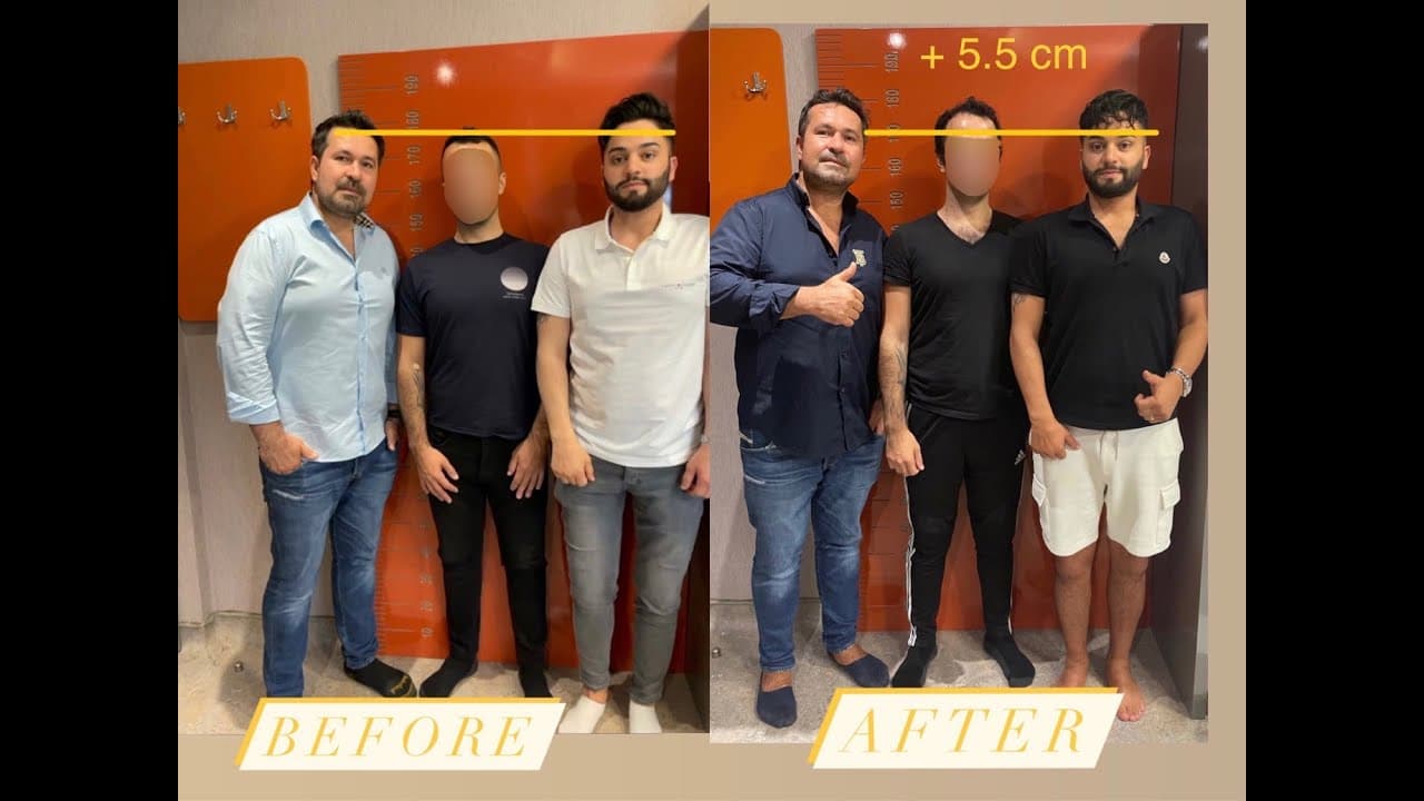 My Limb lengthening surgery in turkey Istanbul. My experience with LON method by Dr. Halil Buldu - YouTube